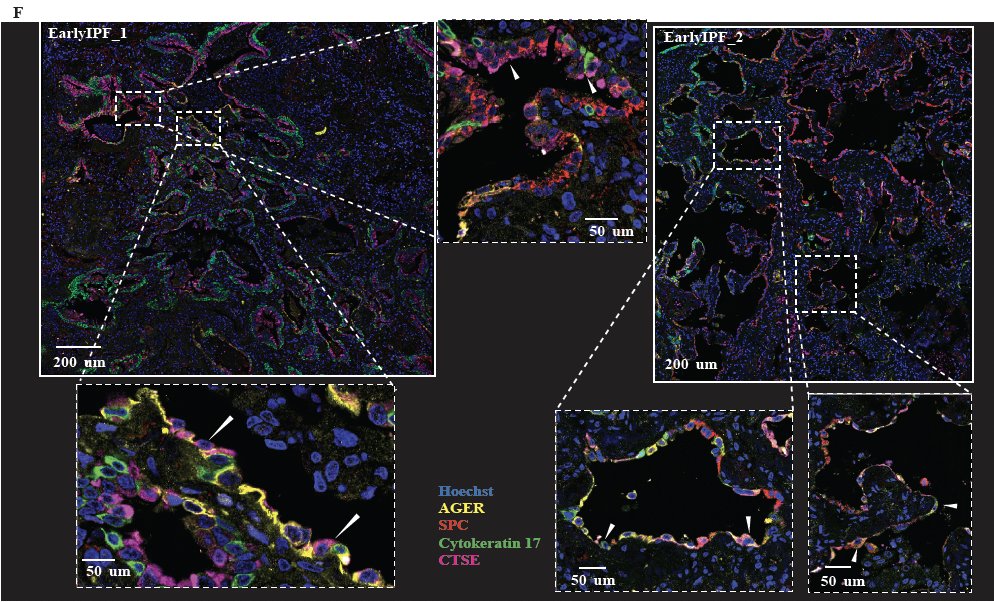 KaminskiMed's tweet photo. snRNASeq of Early IPF lungs reveals emergence of aberrant basaloid cells &amp; alveolar intermediate epithelial states &amp; marked loss of AT2 and AT1 cells in early IPF. 
These changes associate  with subsequent disease progression 🙀 
#EarlyIPFisIPF
https://t.co/yyX28bn7D2 https://t.co/URs5tZiofo