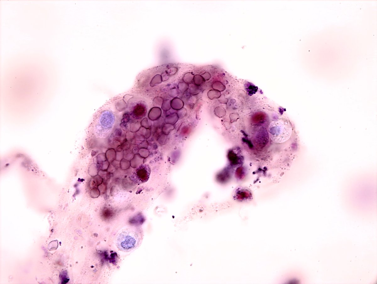 jrseltzer's tweet photo. Mixed cellular cast containing mostly RBC's and some WBC's - brightfield with SM stain - from patient with hemoptysis and AKI - #UrinarySediment #UrineMicroscopy https://t.co/sPhUAbtiRA