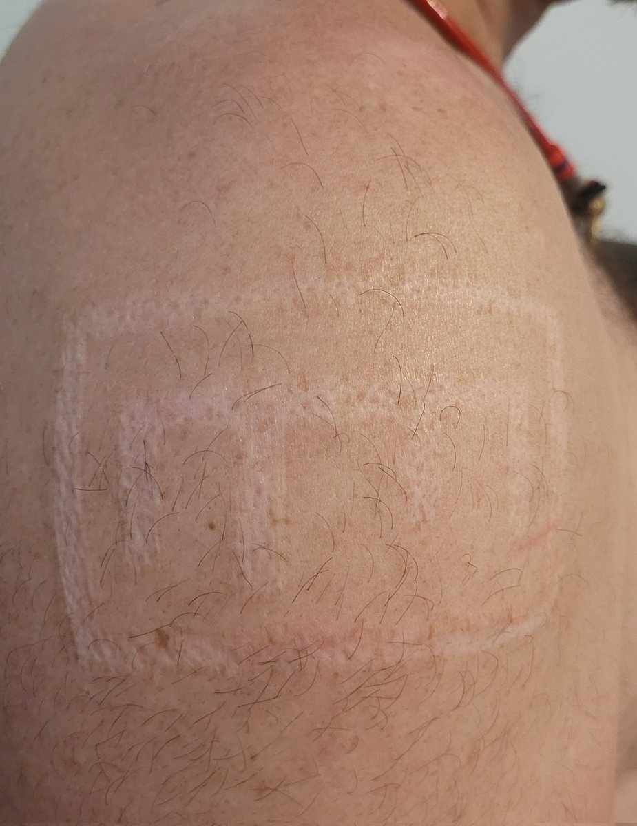 Redwolf8784's tweet photo. @homuncuIus101 I actually took too good of care of it and it healed a little bit more than I intended. The last picture is it 10 years old https://t.co/aAhhtxEjRV