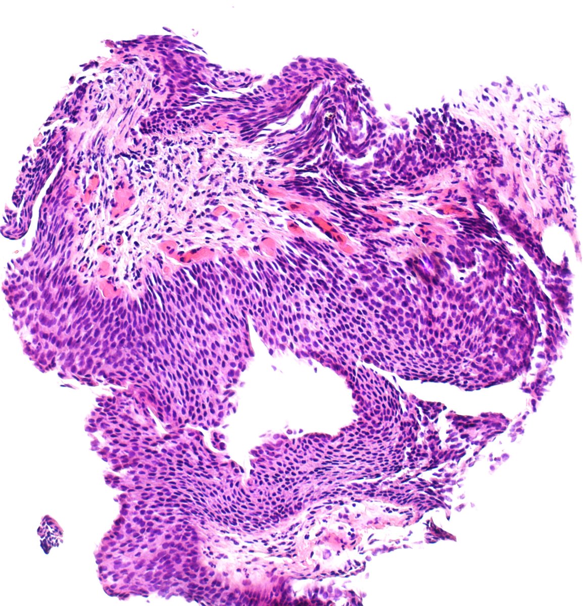 GuannanTiffany's tweet photo. 🧩 Urethral riddle
Female urethral lesion. 🤔
We see a glandular proliferation in the urothelial tract.
How many differentials can you think of?
And what would be your diagnosis in this case?
One related case is attached for comparison. 👇
#DxMindMap #GUPath #UrethralPath #PathTwitter @JHUpath