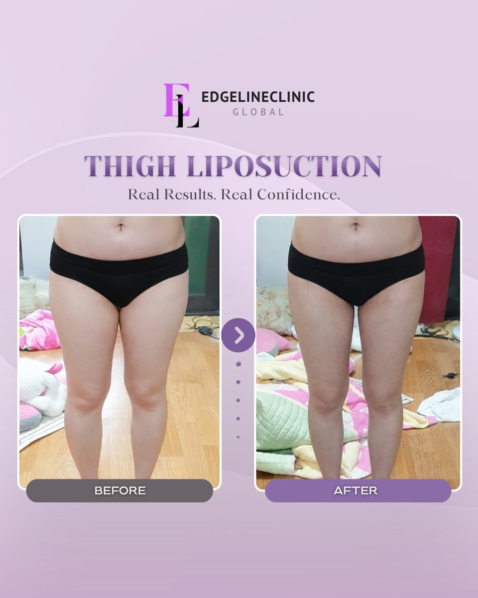 edgeline_global's tweet photo. A more refined thigh contour and smoother lower-body balance can transform how the legs appear overall. 

Book today!
WhatsApp: +82 10 3970 2135
Email: edgelinegangnam@naver.com
WeChat: edgeline_gangnam
LINE: @343tnxkn

#thighliposuction #korealiposuction #koreaplasticsurgery https://t.co/6inRwqORiL