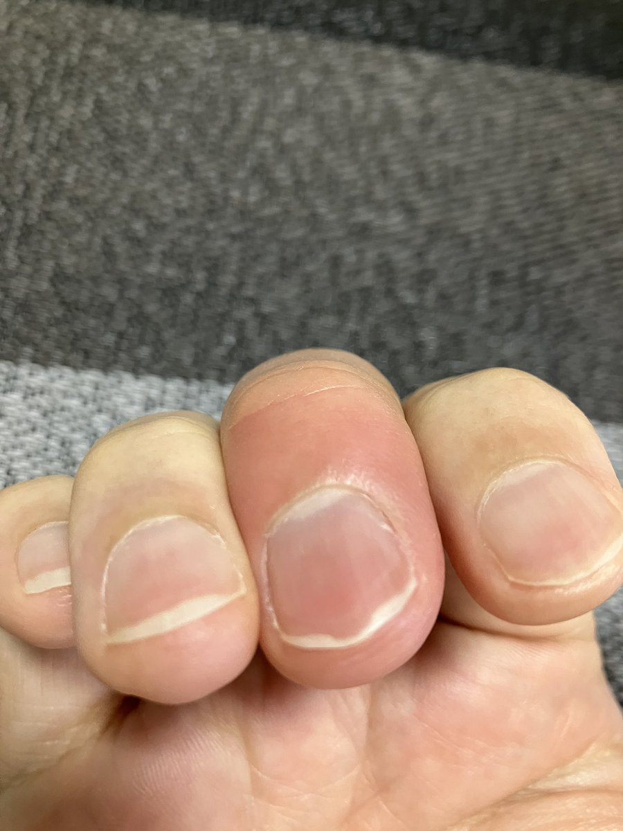 dol___ota's tweet photo. 昨日から指が痛ぇよ😭 https://t.co/UmaLN9B0xq