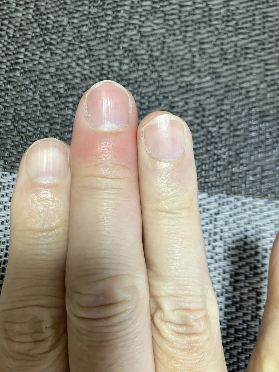 dol___ota's tweet photo. 昨日から指が痛ぇよ😭 https://t.co/UmaLN9B0xq