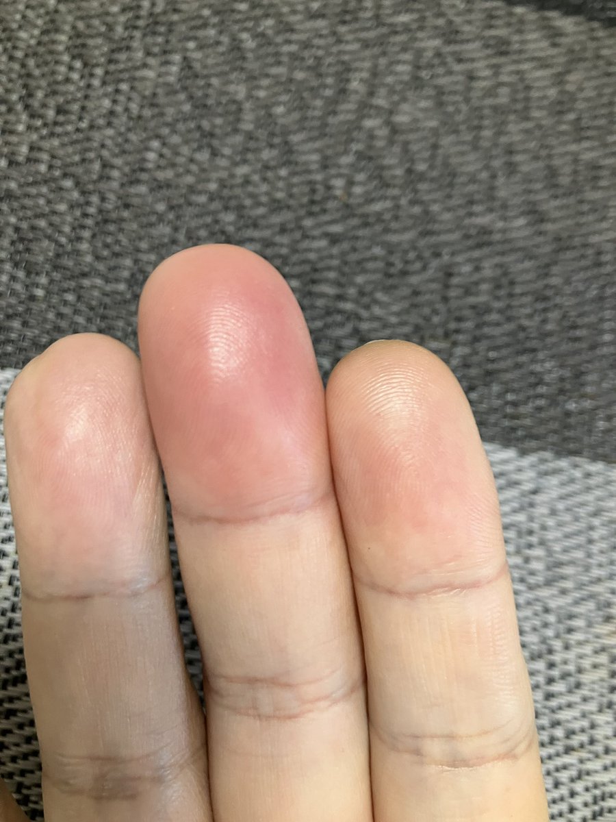 dol___ota's tweet photo. 昨日から指が痛ぇよ😭 https://t.co/UmaLN9B0xq