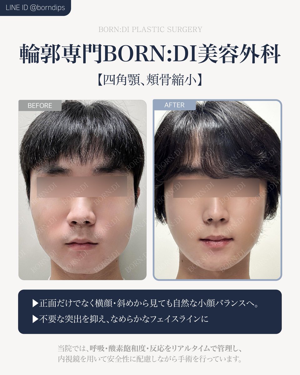 borndips's tweet photo. ナチュラルに垢抜けたいなら
【ボンディ整形外科】の輪郭・小顔手術💎
✔️正面だけでなく横顔・斜めから見ても
自然な小顔バランスへ。
✔️ 骨の位置・角度まで細かく設計
✔️不要な突出を抑え、なめらかなフェイスラインに 📷#韓国整形 #渡韓整形 #整形垢さんと繋がりたい https://t.co/BD54hzpaH5