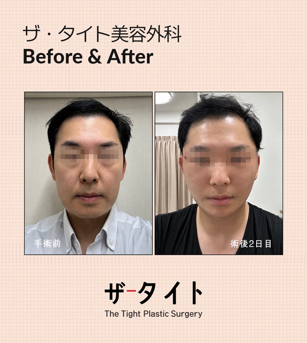 TheTight_ps's tweet photo. お世話になっております😊
ザ・タイト日本担当のキムです🩷

先日切開リフトを受けられ、術後２日目にご帰国された日本の患者様の症例写真をご紹介したいと思います🥰

糸リフトでは十分な効果を感じられず、切開リフトをご決断され、今回初めて韓国にお越しいただきましたが、手術結果にもご満足いただけたとの口コミをカンナムオンニにご投稿いただきました✨

術後2日目とは思えないほど腫れや内出血も少なく、自然に引き上がったフェイスラインがとても印象的です🌷

今後の経過もとても楽しみな症例ですね😊

＃切開リフト