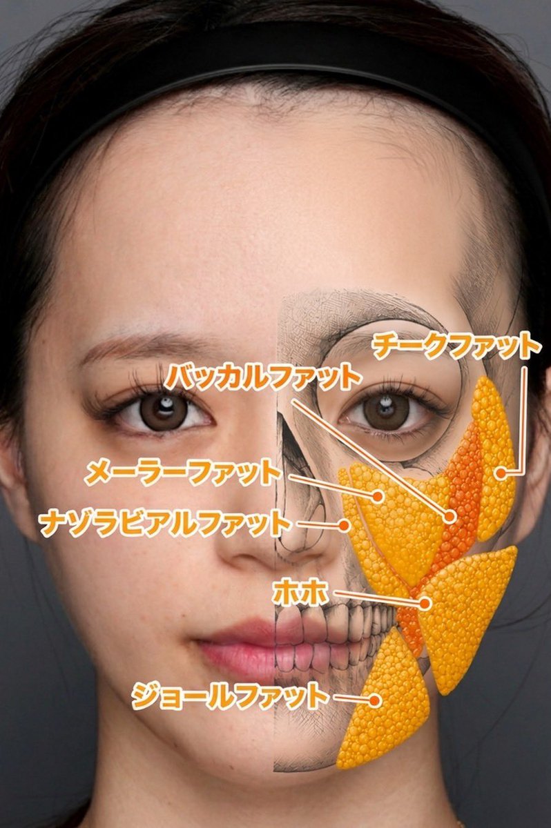 dr_omiomi's tweet photo. これには正解があります。
人間は顔を見るとき、目を基準に大きさを判断する傾向があります。

左の顔

目が顔の上方にある
顎までの距離が長い
下顔面が大きい

↓

脳は「顔全体が大きい」と認識しやすい

右の顔

目が顔の下方にある
額が長い
顎が小さい

↓

脳は「顔全体が小さい」「小顔」と認識しやすい

実際には外周が同じでも、

下顔面が長い → 顔が大きく見える
下顔面が短い → 顔が小さく見える

という認知バイアスが働きます。

これが美容外科でいう

中顔面短縮
人中短縮
チークトップを上げる
Vライン形成

が小顔に見える理由そのものです。
小顔に見えると垢抜けて見えます。

実際には、
正面から見た時の小顔感で特に重要なのは、ジョールファット・頬の脂肪・ナゾラビアルファットです。

この部分のボリュームが多いと、下顔面が横にも縦にも大きく見え、顔全体の余白が増えてしまいます。

一方で、

✅ ジョールファットを減らしてフェイスラインをシャープにする
✅ 頬のボリュームを適切に調整する
✅ ナゾラビアルファットをスッキリさせる
✅ チークトップを高く見せる

ことで、中顔面はコンパクトに、下顔面は骨格のラインが際立ちます。

つまり、

「下顔面は引き算、中顔面は位置を上げる」

この考え方によって、左の顔を右の顔に近づけることができます✨