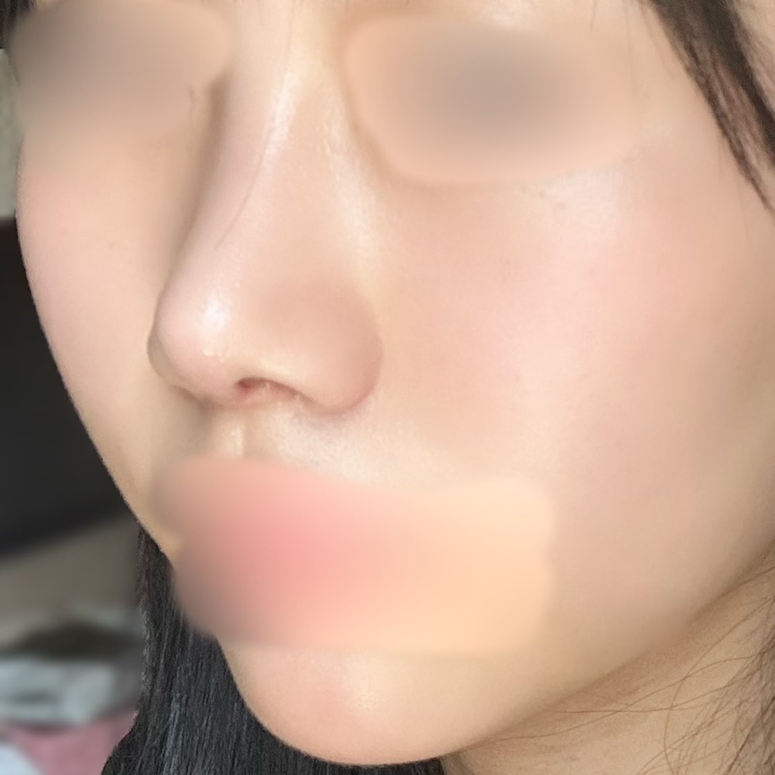 FXu0u's tweet photo. 斜めから見た鼻です綺麗✨鼻柱の傷跡はまだ残っています！今回小鼻には一切触れてなです。 https://t.co/lq6WyqYBbf