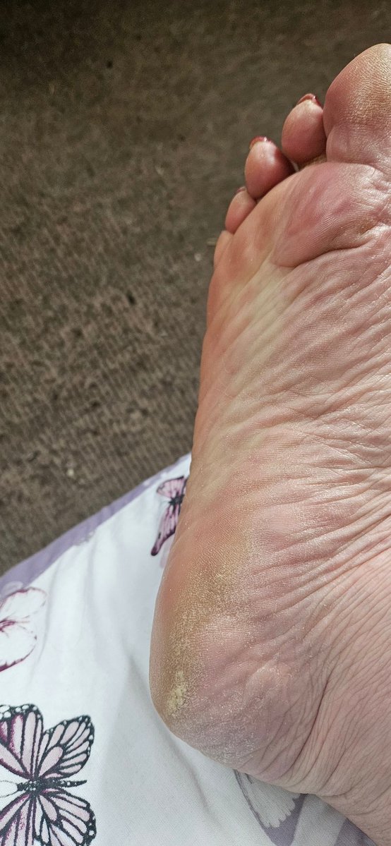 kentshornybbw's tweet photo. Hope you've been enjoying the heat!! #footfetısh #drysoles #maturefeet #bbwescort #dustyheels #footworship #wrinkledsoles https://t.co/mCewhWQzpa