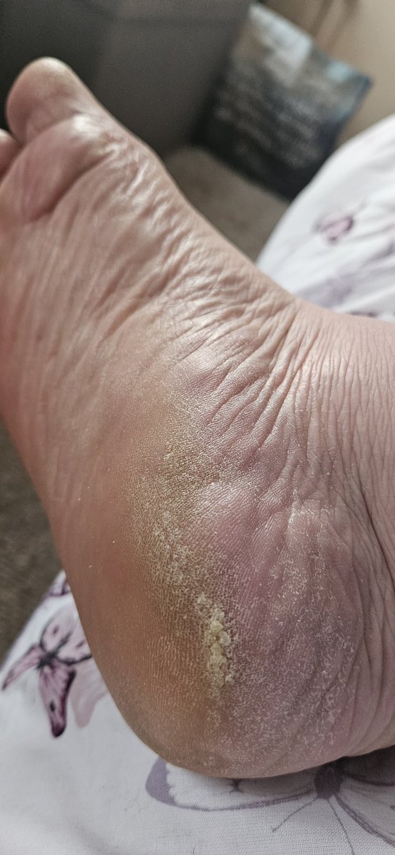 kentshornybbw's tweet photo. Hope you've been enjoying the heat!! #footfetısh #drysoles #maturefeet #bbwescort #dustyheels #footworship #wrinkledsoles https://t.co/mCewhWQzpa