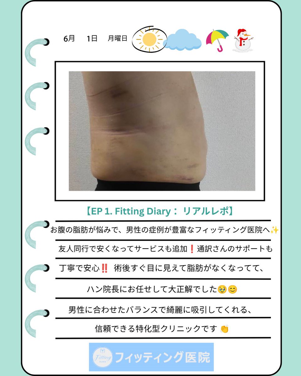 fittingclinicjp's tweet photo. 【EP. 1 : ハン院長にお任せして大正解 😭✨ お腹脂肪吸引のリアル日記】
ピンポーン🔔📝今日のフィッティング日記が到着しました💫

ぽっこり出たお腹の脂肪がずっと悩みで、今回フィッティング医院で脂肪吸引を受けてきました 👨‍⚕️
色んなクリニックを比べたけど、ここは圧倒的にコスパが良くて感動！しかも、友達と一緒に受けることでさらに割引してもらえて、嬉し���追加サービスまで受けられました 💖
なにより嬉しかったのは、男性の脂肪吸引の症例がすごく豊富だったこと！他院ではメンズの症例が少なくて不安だったけど、ここは脂肪吸引特化型だから安心感が違いました 👏 ハン院長は男性の体型に合わせた絶妙なバランスで吸引してくれるので、術後すぐに目に見えてお腹がすっきりしたのが分かって感動…！
全身麻酔の後、一時的に右腕が上がりにくくなる症状（橈骨神経麻痺）が出て最初はすごく不安でしたが、先生が「少し時間はかかるけれど、必ず良くなるから大丈夫」と親身に診断してくださり、その言葉通り今ではすっかり改善してきています 🥺（あの時は本当に救われました…！）
日本語通訳のスタッフさんも最初から最後まで丁寧にサポートしてくれて、こちらの都合にも柔軟に対応していただき感謝しかありません。メンズ脂肪吸引で悩んでいる方がいたら、自信を持っておすすめしたいクリニックです 🏆✨
#フィッティングクリニック #韓国美容 #メンズ脂肪吸引 #お腹脂肪吸引 #メンズ整形 #渡韓整形 #韓国整形外科