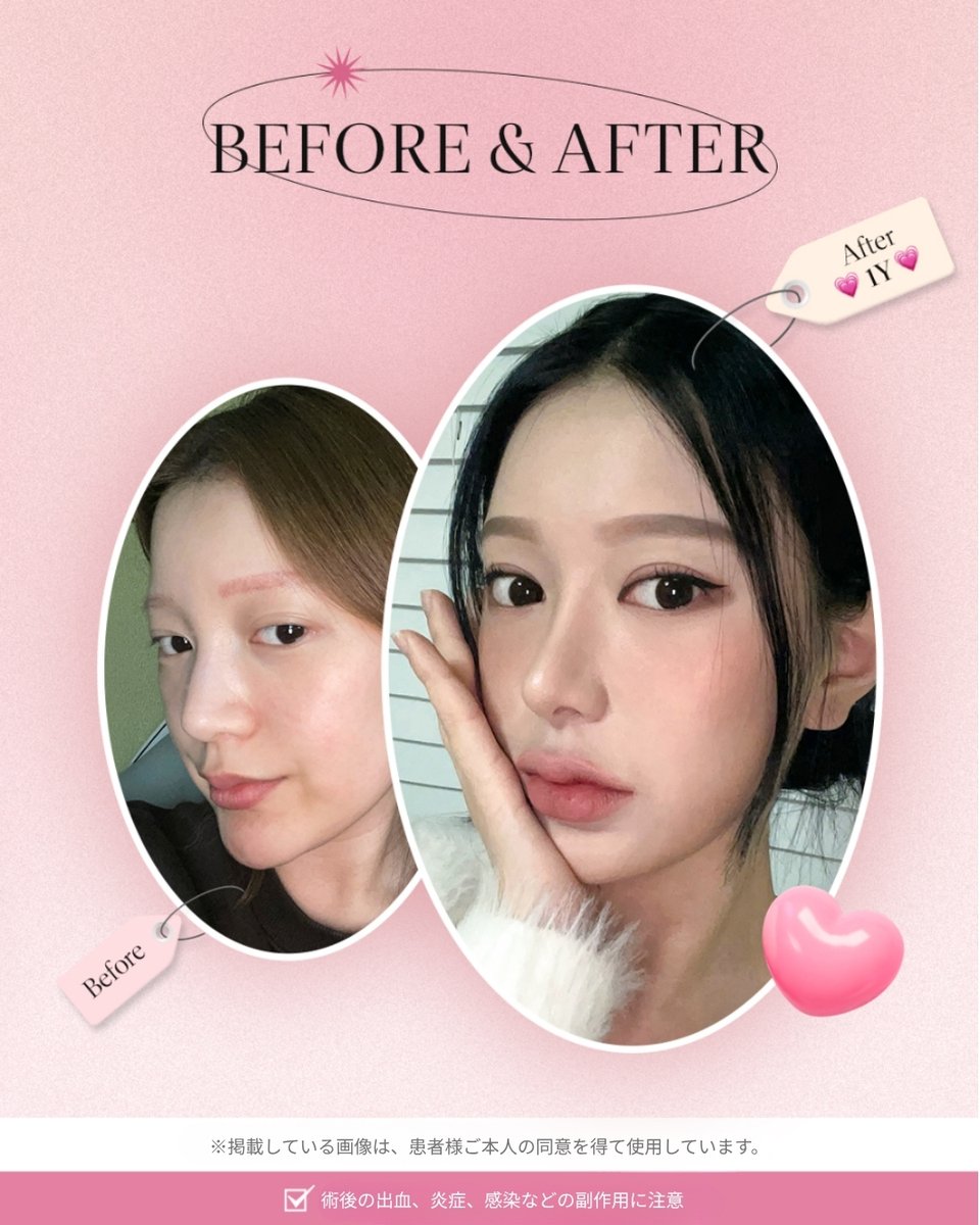 topfacejp's tweet photo. お人形さんのような、もっと大きくはっきりと輝く目元へ✨

「眠そうな目をパッチリさせたい…」
「自分に似合う、華やかな二重ラインを見つけたい！」

そんな理想を叶えるのが、トップフェイスです！

トップフェイスが選ばれる3つの理由💡

徹底した分析と充実したカウンセリング

タイプ別・原因別に見極める、差別化された目元整形

最初から最後まで責任を持って行う責任診療

1年後の症例写真（Before & After）を見ても、とっても自然で華やかな仕上がりに💖
一人ひとりの目のタイプや原因に合わせ、最適なデザインをご提案します。

まずは丁寧なカウンセリングから、あなただけの“理想の目元”を見つけてみませんか？
お気軽にDMまたは公式LINEからお問い合わせください💌

#トップフェイス美容外科 #エンジェルアイ #韓国整形 #目整形