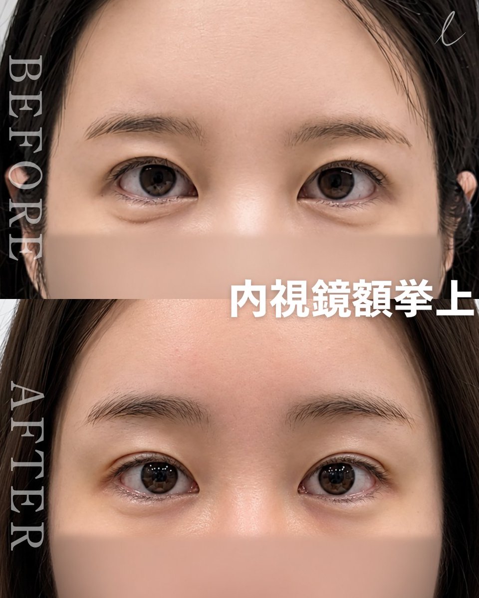 Liffpsjp's tweet photo. 【額リフトは“どこで受けるか”で差が出る】

リーフ美容外科の額リフトは、
内視鏡で神経・血管・筋肉を細かく確認しながら
必要な部分だけを丁寧に剥離。

✔ 重たいまぶたを改善
✔ 下がった眉を自然にリフトアップ
✔ 額のシワを改善
✔ より若々しい印象へ

さらに、一人ひとりの額の形や骨格に合わせた
オーダーメイドデザインを行います。

ただ引き上げるだけではなく、
「違和感のない自然な若返り」を目指します。

額リフトイベント実施中✨

#リーフ美容外科 #額リフト #内視鏡額リフト #切開リフト #若返り整形 #たるみ改善 #眉下がり改善 #おでこのシワ改善 #韓国美容外科 #整形垢さんと繋がりたい #美容垢さんと繋がりたい