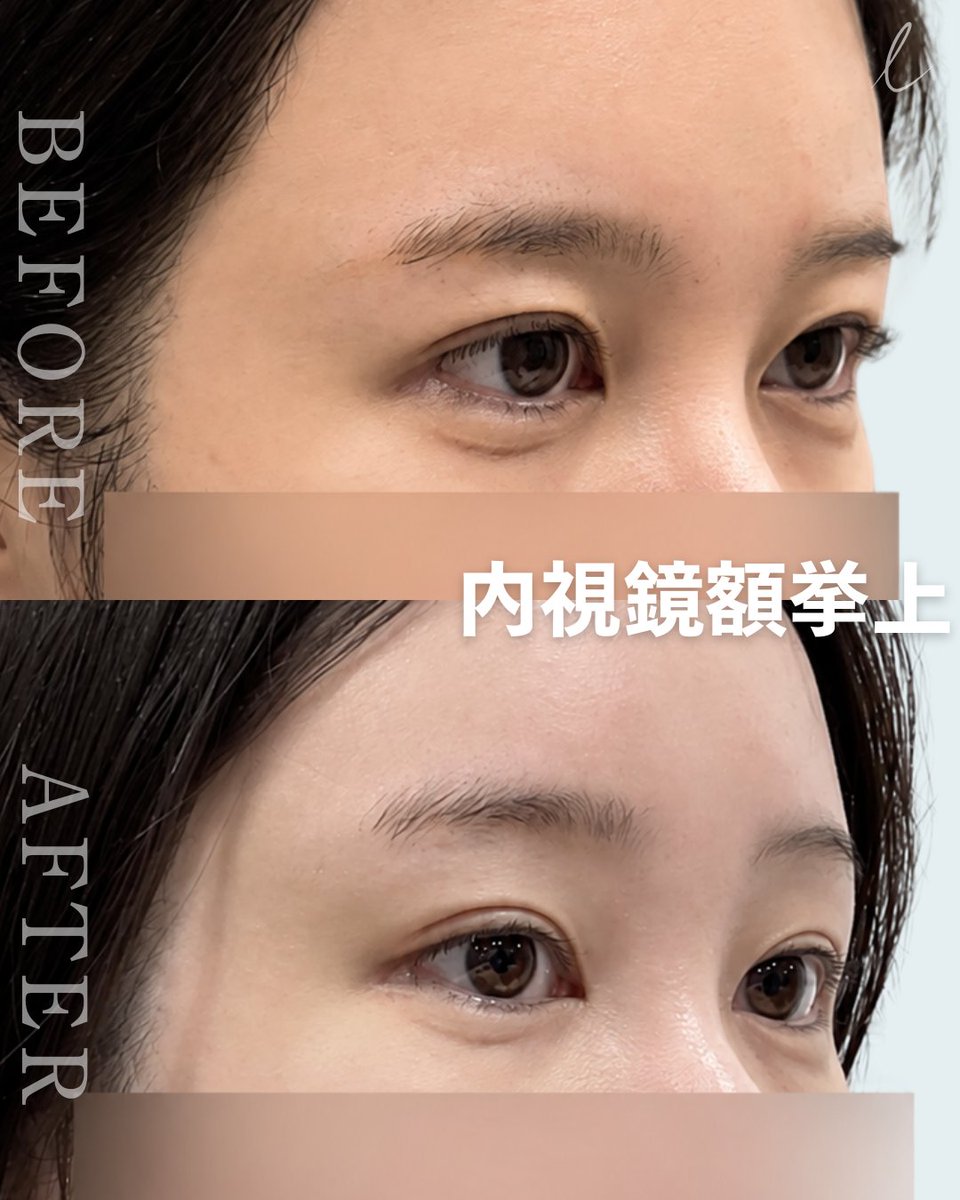 Liffpsjp's tweet photo. 【額リフトは“どこで受けるか”で差が出る】

リーフ美容外科の額リフトは、
内視鏡で神経・血管・筋肉を細かく確認しながら
必要な部分だけを丁寧に剥離。

✔ 重たいまぶたを改善
✔ 下がった眉を自然にリフトアップ
✔ 額のシワを改善
✔ より若々しい印象へ

さらに、一人ひとりの額の形や骨格に合わせた
オーダーメイドデザインを行います。

ただ引き上げるだけではなく、
「違和感のない自然な若返り」を目指します。

額リフトイベント実施中✨

#リーフ美容外科 #額リフト #内視鏡額リフト #切開リフト #若返り整形 #たるみ改善 #眉下がり改善 #おでこのシワ改善 #韓国美容外科 #整形垢さんと繋がりたい #美容垢さんと繋がりたい