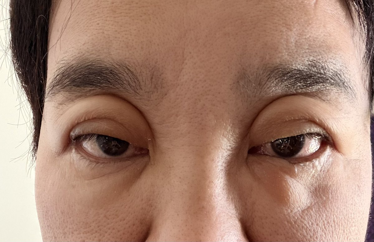 lapisco666's tweet photo. 植毛5日目の朝です
もう完全に誰か分からんくらいに両目が腫れました
ヤバすぎです https://t.co/fibbxU6TFw