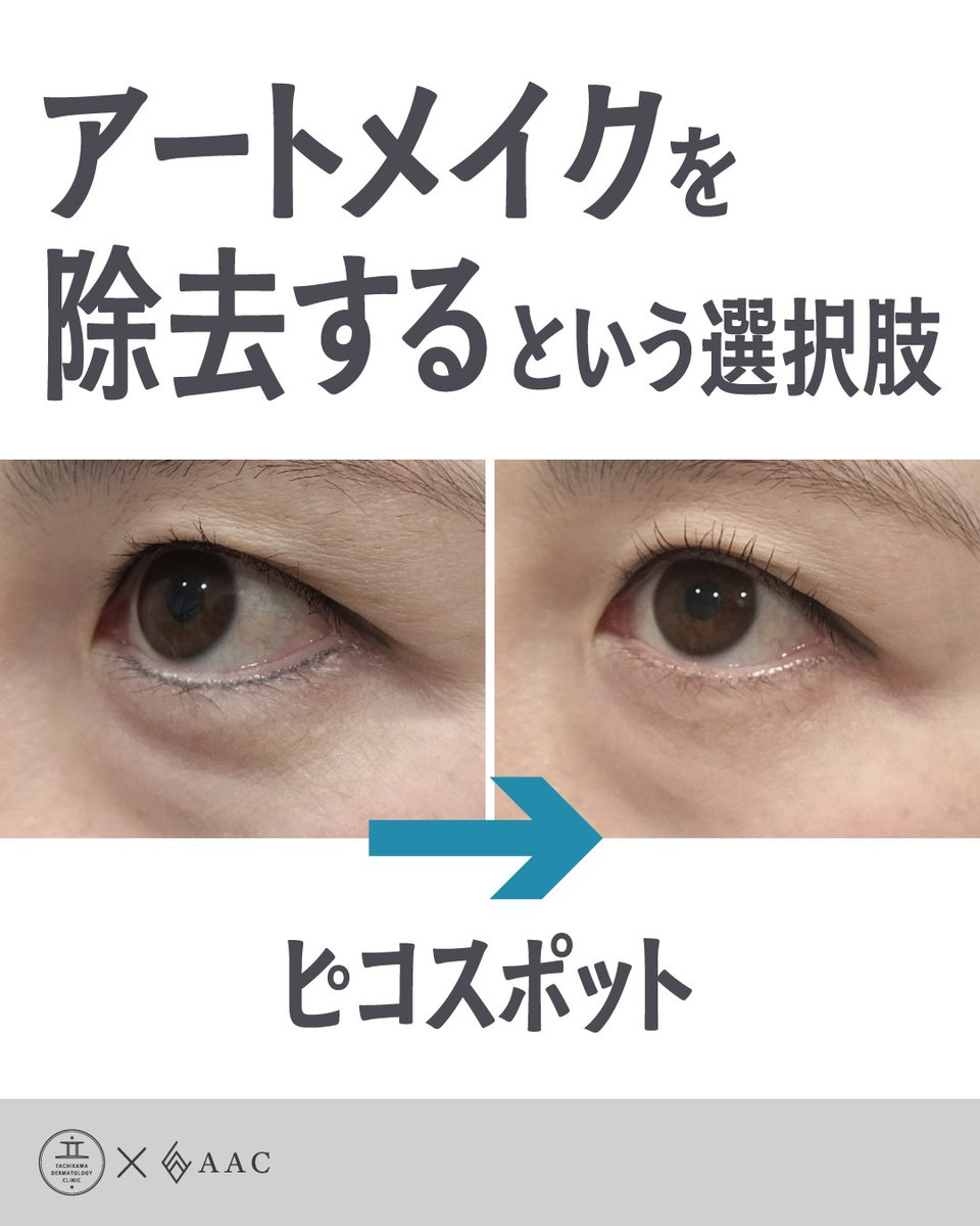 アートメイク除去アイラインの経過をまとめてみました👀 ✔️ 好みの