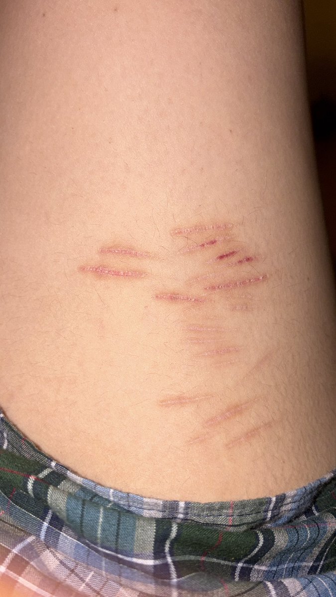 rainbowt0aster's tweet photo. Ignore my fat ass leg/ current scar check #shedtwt #shtwt #scarspo https://t.co/9ZKdwCTAxR