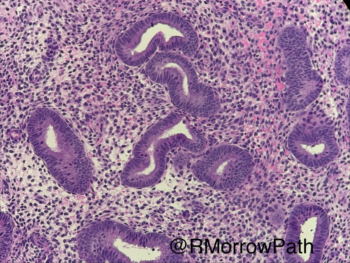 RMorrowPath's tweet photo. What phase is this endometrium in and how do you know?? #gynpath #pathology https://t.co/zpvfHEMl06