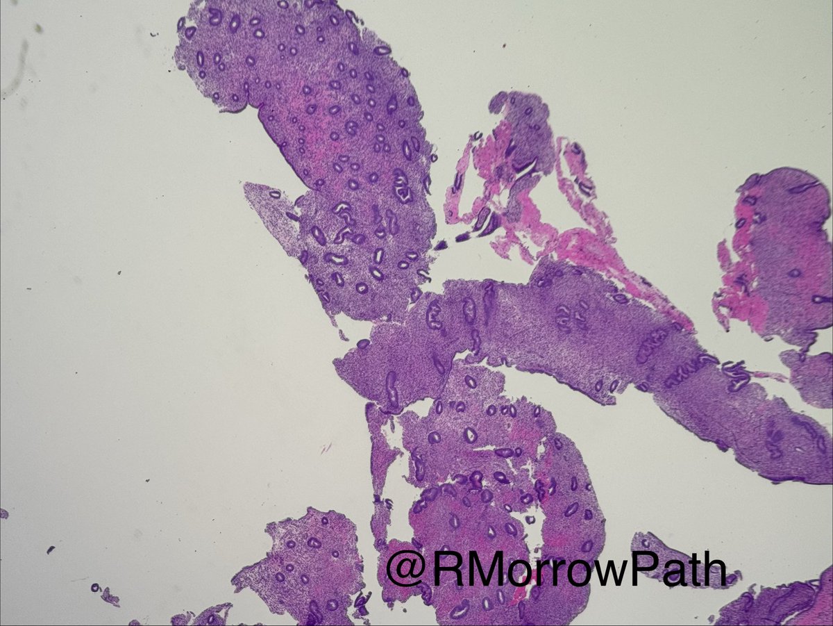RMorrowPath's tweet photo. What phase is this endometrium in and how do you know?? #gynpath #pathology https://t.co/zpvfHEMl06