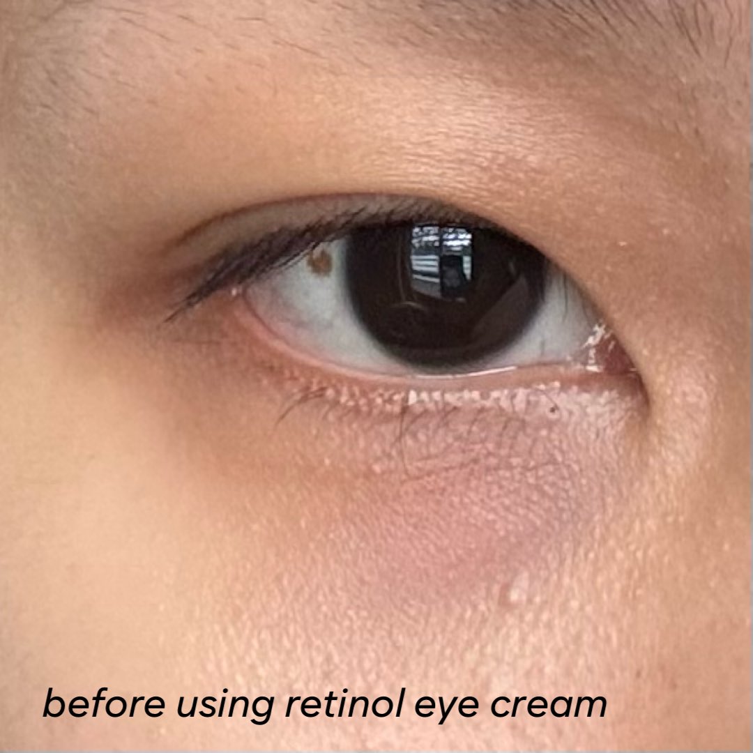 jeceskindiary's tweet photo. “pake eye cream itu ga ngaruh!”

but this is how my eyes look after daily eye cream use https://t.co/4psVzmgYI2