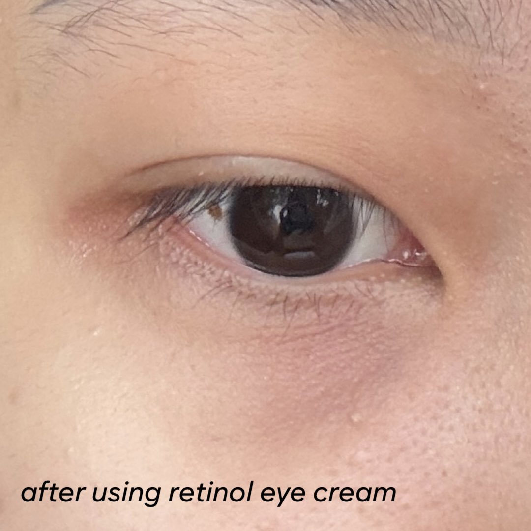 jeceskindiary's tweet photo. “pake eye cream itu ga ngaruh!”

but this is how my eyes look after daily eye cream use https://t.co/4psVzmgYI2