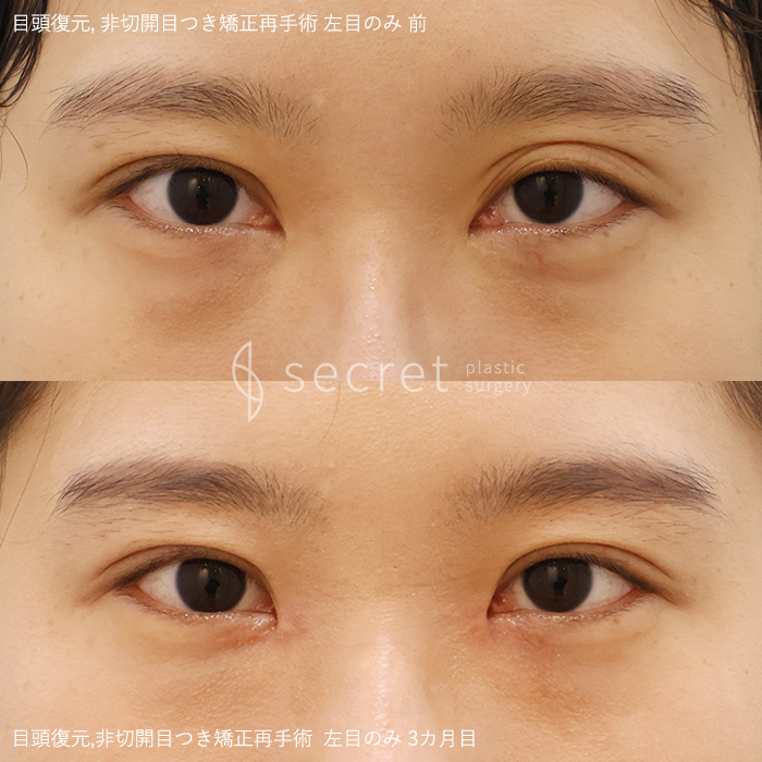 secretpsm's tweet photo. [目頭復元+非切開目つき矯正(写真:右側)]
▶️ピンク粘膜部位の見えすぎ
▶️目が寄ってみえる印象
▶️三重瞼/高い位置に二重ライン(片目)

柔らかく自然に整った目元へ改善🌹
🔗https://t.co/JgjeEFm0M6

お問合せ/写真カウンセリング
💚LINE📲secretpsm

#目修正　#目頭修正　#目頭再建　#三重瞼 https://t.co/kcGwngSFD9