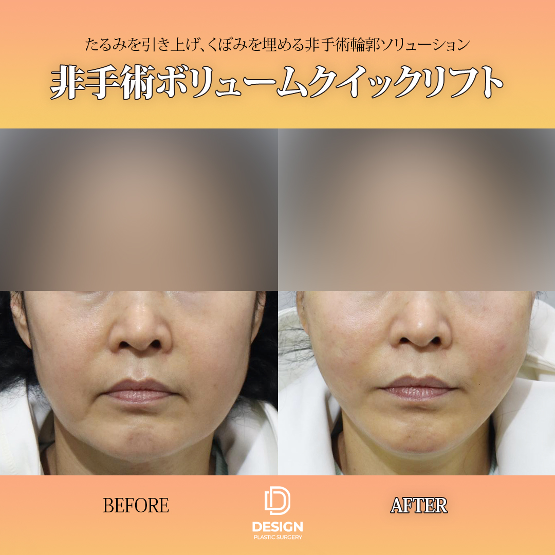 designprsjp's tweet photo. ✔️糸リフト
👨‍⚕️クォン・ギヒョン 代表院長

⚠️手術および施術後には、出血・感染・炎症などがあり差が生じる可能性があります。

お問い合わせhttps://t.co/mOnl8ZjdKW

#リフティング　#釜山整形外科
#釜山美容 https://t.co/LbXyjyUaeS