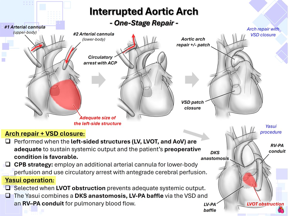 WithAScalpel's tweet photo. Interrupted Aortic Arch — Surgical Pathways🗺️

👉One-stage repair: Perform Arch repair + VSD closure when anatomy is favorable; choose Yasui (DKS + LV-PA baffle + RV-PA conduit) for significant LVOT obstruction.
👉Staged repair: Use bilateral PAB + PDA stent or Arch repair + main PAB for stabilization, then proceed later to Arch repair + VSD closure or Yasui.
👉Biventricular repair: If the left heart is adequate, aim for Arch repair + VSD closure; use Yasui when direct LV outflow is not sufficient.
👉Single-ventricle pathway: If the left heart is too small, choose a Norwood-type strategy with DKS + Arch repair + RV-PA conduit/BT shunt, followed by Glenn and Fontan.

@OungSavly @AEPCcongenital @WGACHDChair @iamritu @CASivaram1 @loomba_rohit @alex1708ander @SIwa23288585 @swatigar @cardiopedhnn