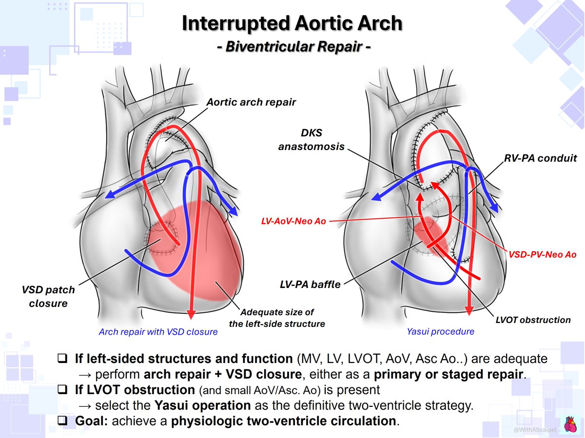 WithAScalpel's tweet photo. Interrupted Aortic Arch — Surgical Pathways🗺️

👉One-stage repair: Perform Arch repair + VSD closure when anatomy is favorable; choose Yasui (DKS + LV-PA baffle + RV-PA conduit) for significant LVOT obstruction.
👉Staged repair: Use bilateral PAB + PDA stent or Arch repair + main PAB for stabilization, then proceed later to Arch repair + VSD closure or Yasui.
👉Biventricular repair: If the left heart is adequate, aim for Arch repair + VSD closure; use Yasui when direct LV outflow is not sufficient.
👉Single-ventricle pathway: If the left heart is too small, choose a Norwood-type strategy with DKS + Arch repair + RV-PA conduit/BT shunt, followed by Glenn and Fontan.

@OungSavly @AEPCcongenital @WGACHDChair @iamritu @CASivaram1 @loomba_rohit @alex1708ander @SIwa23288585 @swatigar @cardiopedhnn