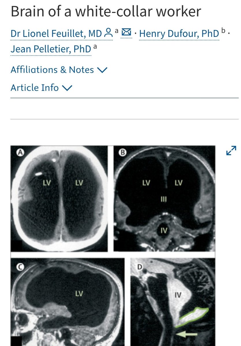 BasedRaddka's tweet photo. this case should make us seriously evaluate many neuroscience paradigms

this guy led a normal life, man was 44-years-old at the time, married with two children, and worked as a civil servant https://t.co/Cpy90wJiaO