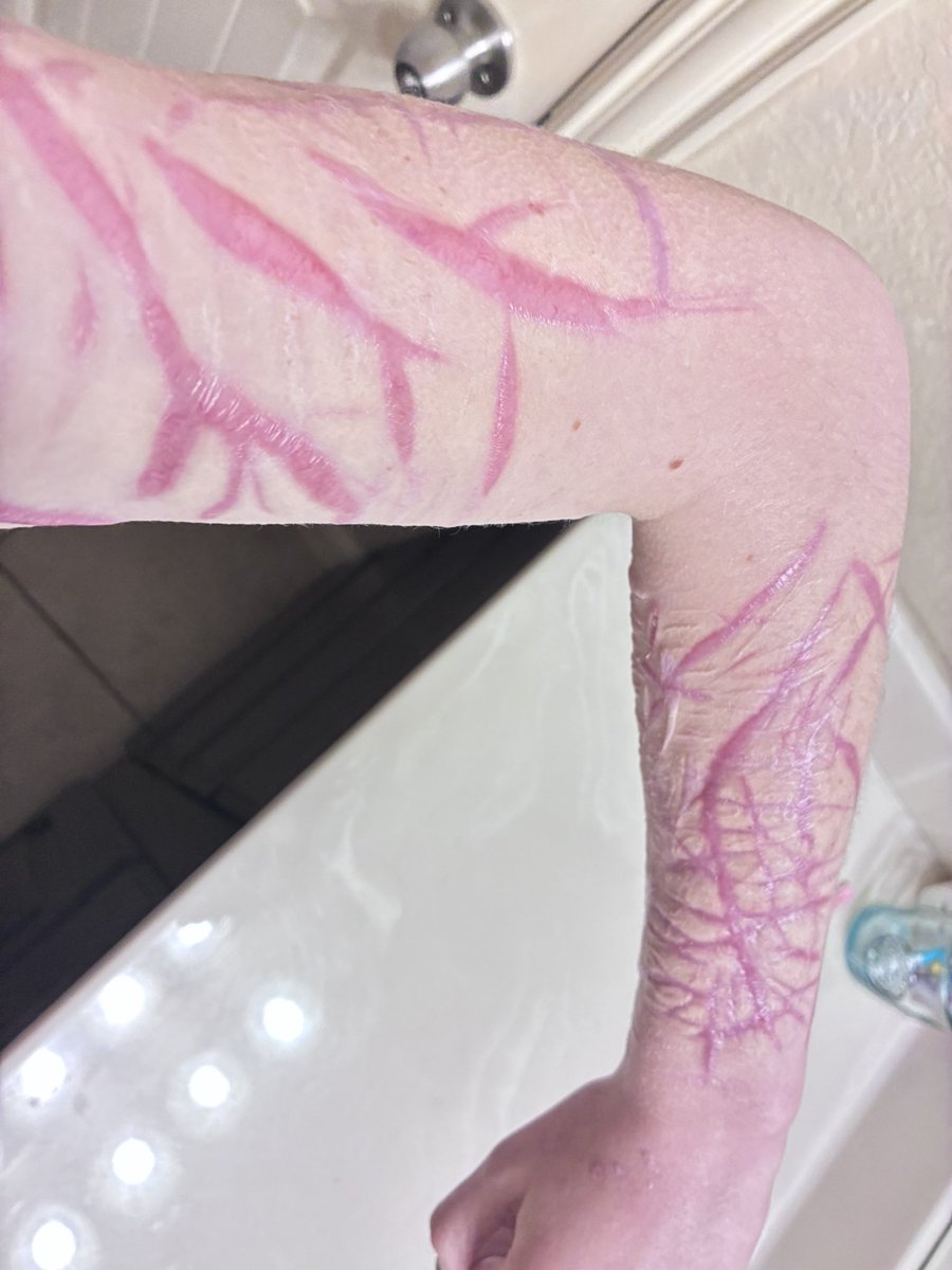 yaoigoonerwife's tweet photo. healed scars! going over them on monday lol https://t.co/pTTQ9sVUBQ