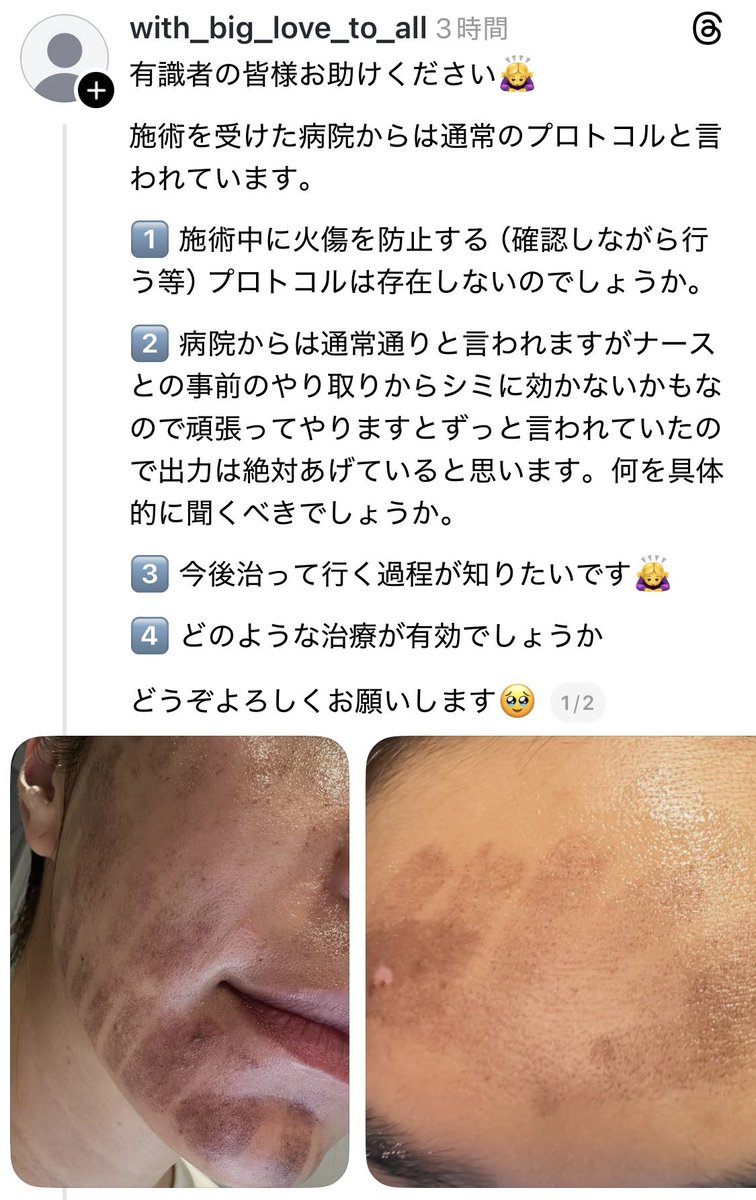 hmweum's tweet photo. 【悲報】若返り施術、ルメッカにて火傷の医療事故が報告される。

病院側は失敗を認めていない様で、通常のプロトコルと説明。皮剥けするまで出力を上げて打ったのか、色素沈着が疑われる経過に。。。

Uビのオリジオ火傷、🐉の脱毛全身火傷事件思い出した。SNS直美怖えええぇ。。。 https://t.co/V7uzgvRI8D