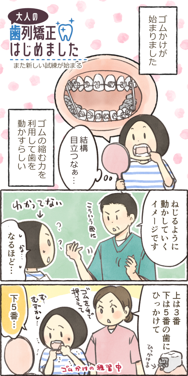 ki7ko's tweet photo. 大人の歯列矯正はじめました。グラついてる歯にゴムかけの恐怖🥶 https://t.co/Q4vJ3ZJhW6