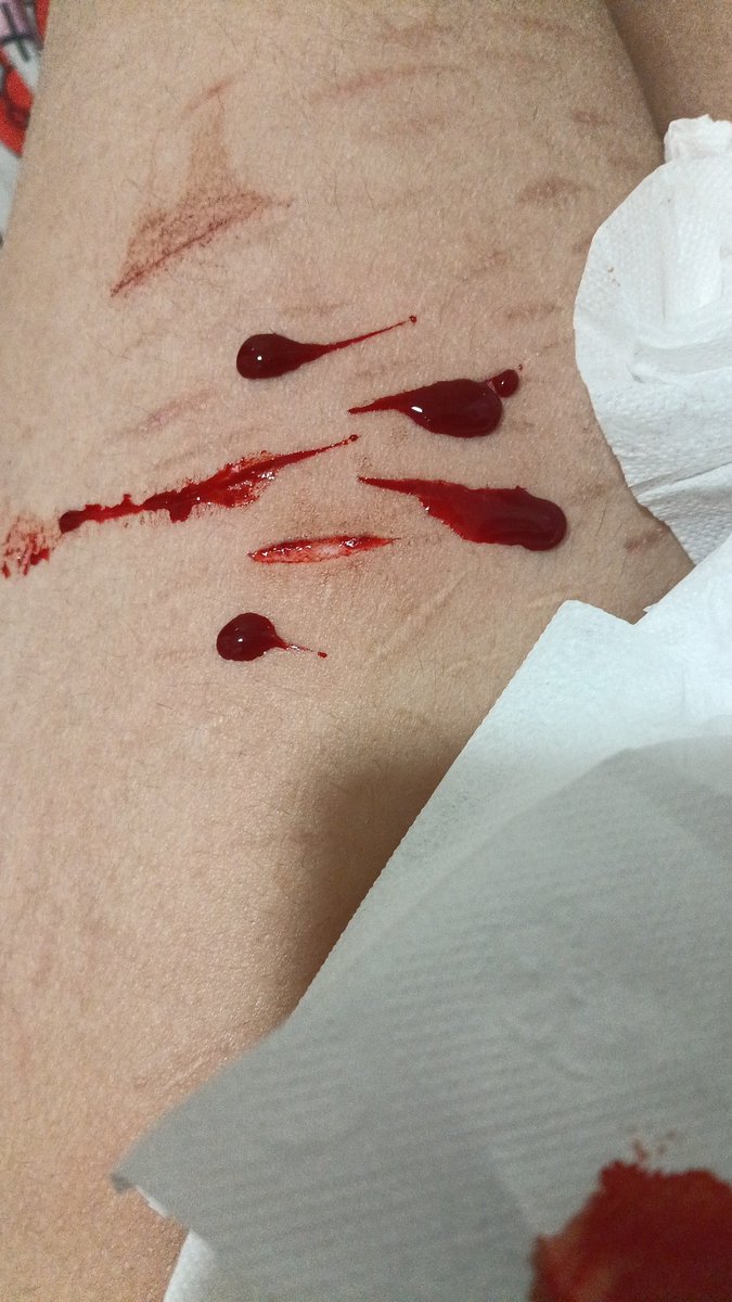 Aleesforme's tweet photo. repost because i got SNIPED, deep styros (i think) maybe baby beans?? so proud of these, snapping razors for the win!!! (do the sound they make when ripping the skin are AWFUL) #slittwt https://t.co/zFamEkPP1N