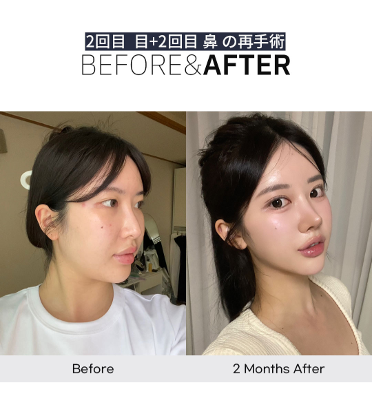 anotherpsjp's tweet photo. アナザー鼻整形症例！
より多くの写真と内容はブログにて🥰
https://t.co/XR3qivKEfx

日本語でのお問い合わせや
オンラインカウンセリングOK🙆‍♀️

公式LINE@anotherpsjp
✉️https://t.co/IxTgvVKNTF🖤

#鼻整形 #韓国整形 #渡韓 #鼻フル #再手術 #肋軟骨 #整形垢さんと繋がりたい #渡韓 https://t.co/69ka49A88z