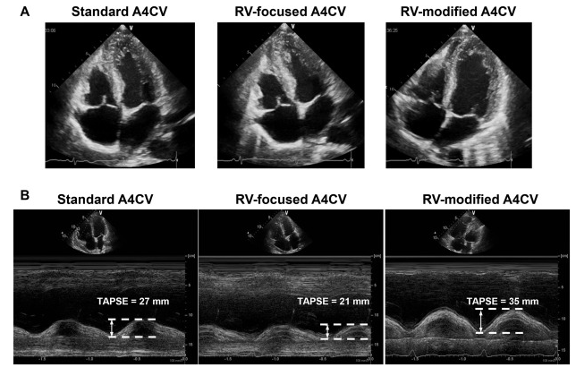 AppCardioNova's tweet photo. 🫀¿Cuál es la vista ecocardiográfica más adecuada para medir el TAPSE?

El plano apical de 4 cámaras modificado.

👉🏼 Presenta una mejor concordancia con el strain del ventrículo derecho
👉🏼 Disminuye los errores relacionados con la angulación del haz de ultrasonido

🔗 DOI: 10.1016/j.echo.2024.12.013