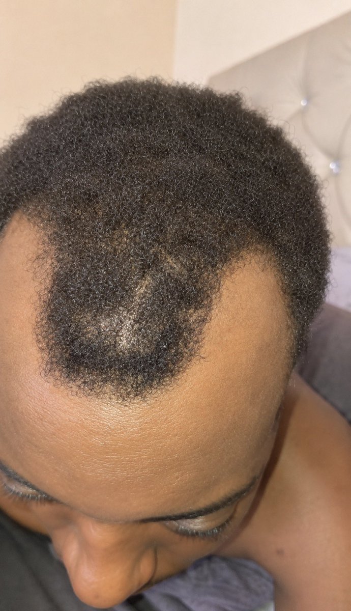 FwTrex's tweet photo. What is the solution to fix his hairline? https://t.co/RGWm0eJ0pS