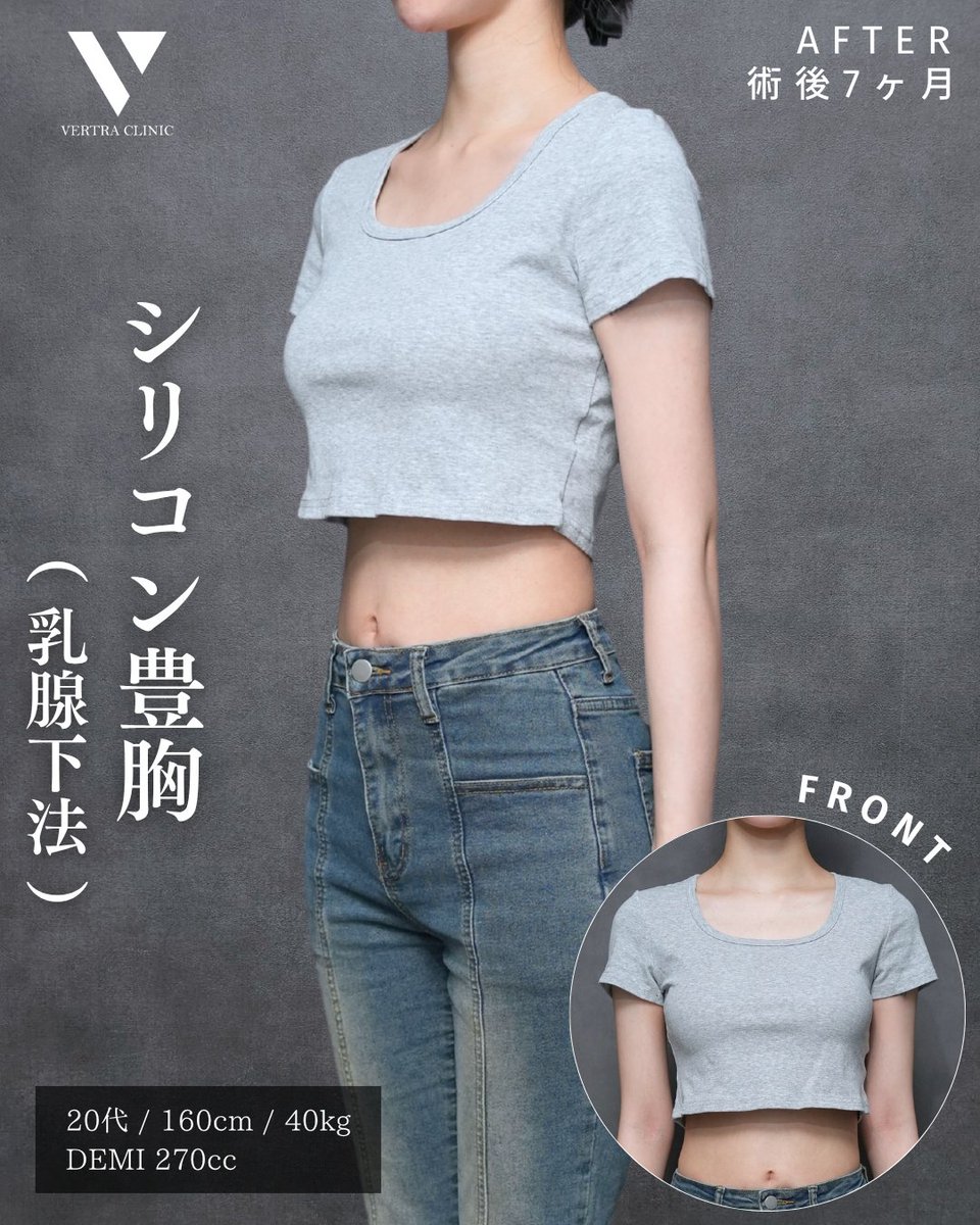 vertraclinic's tweet photo. 《 施術内容 》   
シリコン豊胸(乳腺下法)      

《 執刀医 》   
大阪院院長 河中 聡之(@Dr_kawanaka)      

《 詳細 》   
女性/20代/160cm/40kg   
シリコンバッグ：motiva エルゴノミクス2   
シリコンサイズ：DEMI 270cc   
挿入部位：脇下 https://t.co/pCBBjhJesS