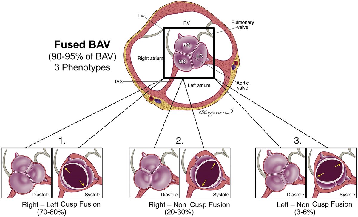 AppCardioNova's tweet photo. 📚 Según el consenso internacional, existen tres tipos principales de Válvula aórtica bicúspide:

1️⃣ VAB con fusión completa de cúspides
2️⃣ VAB de dos senos
3️⃣ VAB con fusión parcial de cúspides, también llamada forma frustrada https://t.co/FosjP6Bf6x