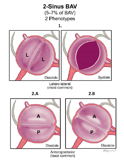 AppCardioNova's tweet photo. 📚 Según el consenso internacional, existen tres tipos principales de Válvula aórtica bicúspide:

1️⃣ VAB con fusión completa de cúspides
2️⃣ VAB de dos senos
3️⃣ VAB con fusión parcial de cúspides, también llamada forma frustrada https://t.co/FosjP6Bf6x