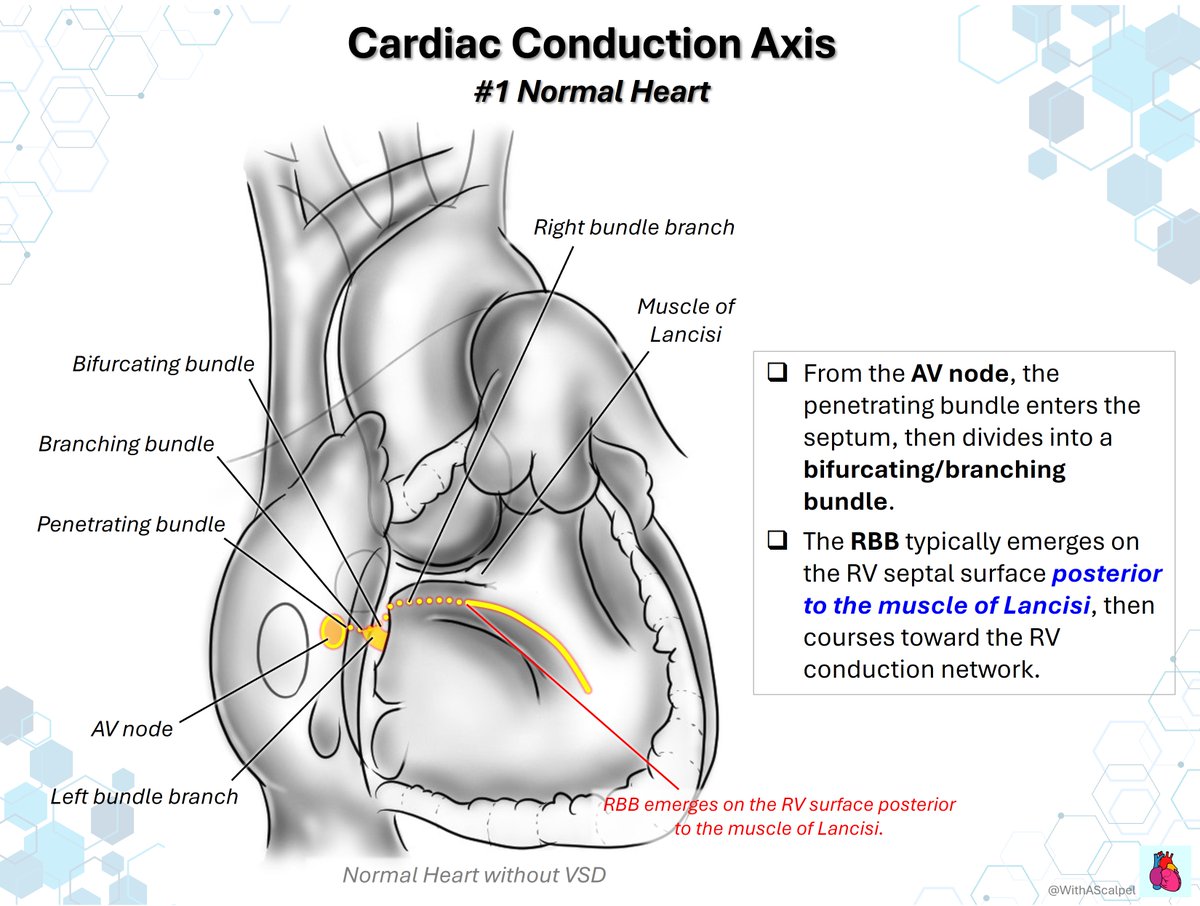 WithAScalpel's tweet photo. Cardiac Conduction Axis in Perimembranous VSD

👉In the normal heart, the RBB emerges on the RV septal surface posterior to the muscle of Lancisi.
👉With outlet extension, the RBB may run closer to the outlet margin, covered by the posterior limb of the trabecula septomarginalis, and emerge distal to the medial papillary muscle (MPM).
👉With inlet extension, the RBB shifts toward the inlet-side edge of the VSD, making the MPM an unreliable landmark.