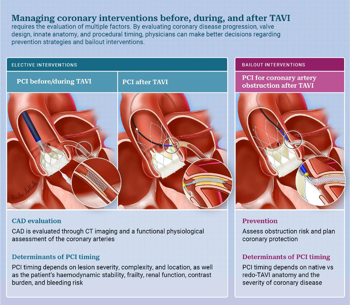 DFCapodanno's tweet photo. This State-of-the-Art review provides a comprehensive and practical overview of coronary interventions related to TAVI, encompassing coronary evaluation and physiological assessment, the indications and timing of percutaneous coronary intervention before and after valve implantation, and strategies for managing coronary obstruction. https://t.co/yojhLj5N5p