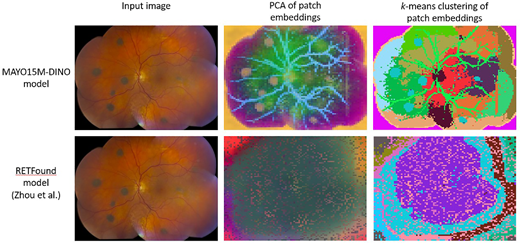 ARVOtvst's tweet photo. Lauren A. Dalvin et al. from the Mayo Clinic develop a model for automated early detection of choroidal melanocytic lesions from fundus images. 
https://t.co/YXbov3yIYk https://t.co/6tLINIJNk1
