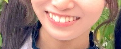 Tooth___fetish's tweet photo. ん？これ治療されて歯並びも変わった🤔🤔 https://t.co/BliCKvEnI4