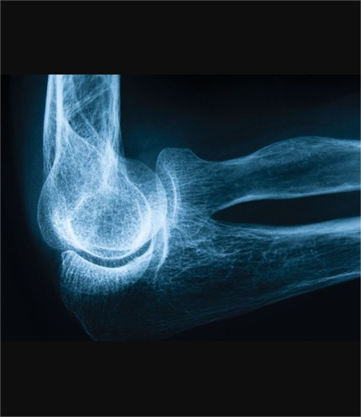 forallcurious's tweet photo. 🚨: Japanese scientists have developed a pill that can regenerate broken bones tissues in record time and reverse Osteoporosis https://t.co/9xf9gaYPA7