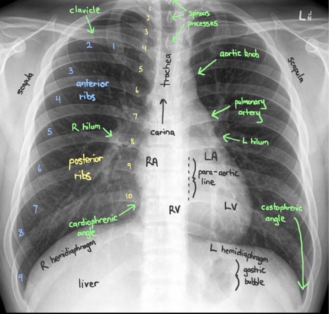 TrackYourHeart's tweet photo. Chest X-ray interpretation https://t.co/mvjIQM6qy0
