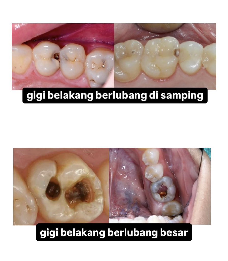 dentaldentsambu's tweet photo. @tanyarlfes Halo teman2 di sekitar Jakarta Pusat yang memiliki keluhan gigi seperti digambar dan ingin dilakukan perawatan boleh DM aku ya! free of charge yaah. terimakasih #koasgigijkt #koasgigi #salemba #jakpus https://t.co/ULr31sKDXK