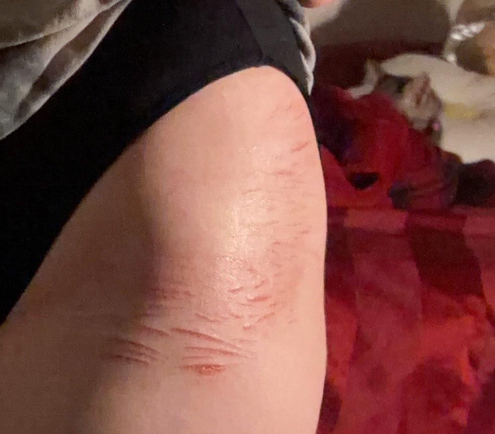 Love_Princess67's tweet photo. Anywho!! Scars freshly moisturized ^3^ #Shedtwt #shtwt #scartwt #scarspo?? https://t.co/YIazXezy5b