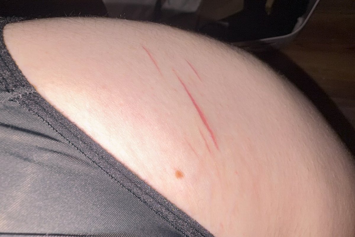 Love_Princess67's tweet photo. Anywho!! Scars freshly moisturized ^3^ #Shedtwt #shtwt #scartwt #scarspo?? https://t.co/YIazXezy5b