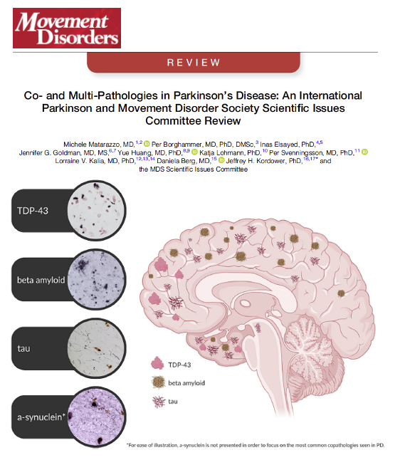 MichaelOkun's tweet photo. Parkinson’s disease may not be just one disease protein. Co-pathology means multiple abnormal proteins and disease processes may exist together in the same brain. Matarazzo and colleagues describe in a new paper in Movement Disorders how Parkinson’s disease frequently includes overlapping pathologies such as tau, beta amyloid, TDP-43, vascular disease and inflammation, in addition to alpha-synuclein.
Key points:
- Most folks w/ Parkinson’s disease appear to have multiple co-existing brain pathologies rather than a pure alpha-synuclein disorder.
- Tau, beta amyloid and TDP-43 pathologies were linked to faster progression, cognitive decline and more severe symptoms in many studies.
- The review highlights how genetics, inflammation, vascular disease, microbiome changes and immune dysfunction may all interact to shape Parkinson’s progression.
My take: This paper is important because it challenges the old idea that Parkinson’s disease is simply a dopamine disorder or just a synuclein disorder. The future of Parkinson’s treatment may require us to target multiple biological pathways simultaneously. We may need to think less about a single culprit and more about an entire ecosystem of interacting disease processes.
Here are 5 points that resonated w/ me:
1- Parkinson’s disease is likely more biologically complex than we previously imagined.
2- Co-pathologies may help explain why symptoms and progression differ so dramatically between folks.
3- Tau and beta amyloid pathology may contribute importantly to thinking and memory decline in Parkinson’s disease.
4- Inflammation, vascular disease and immune dysfunction may not just accompany Parkinson’s disease, they may actively shape progression.
5- Precision medicine approaches that combine biomarkers, genetics and pathology may ultimately help us personalize therapies and improve outcomes.
https://t.co/B3kZC2Mmmf @movedisorder